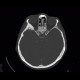 Menigioma en plaque, sphenoid bone: CT - Computed tomography